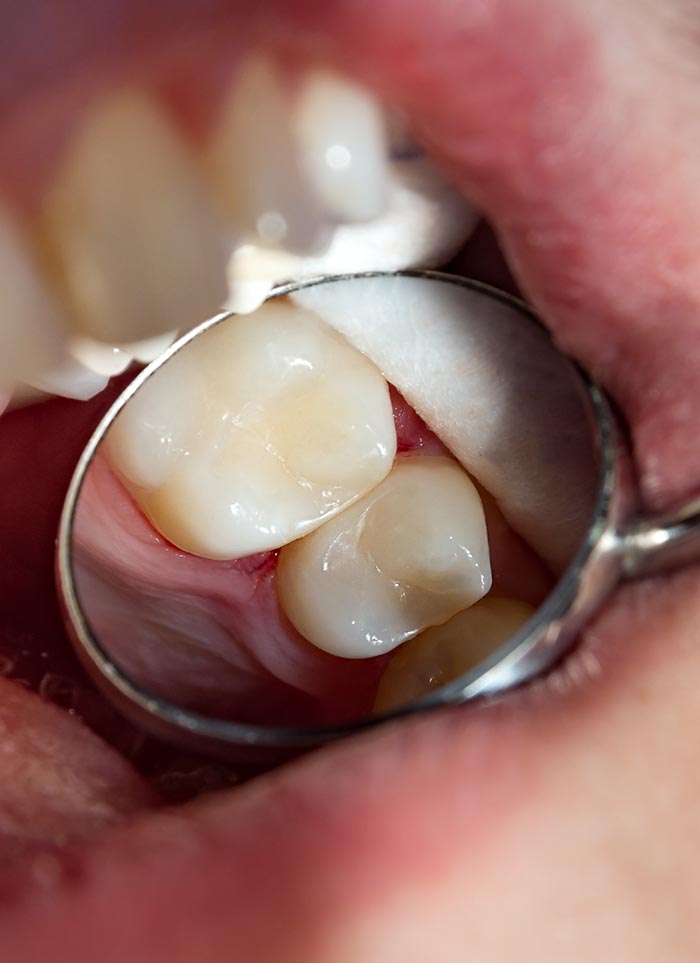 Dental Fillings Ottawa Ontario
