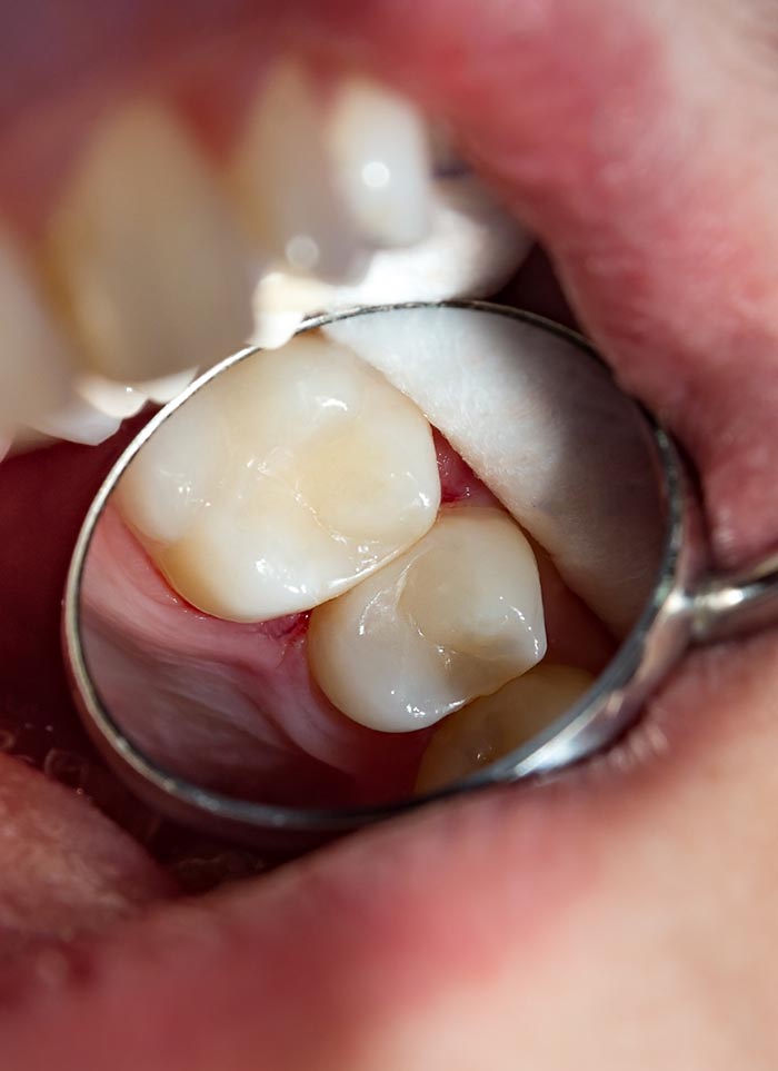 Dental Fillings Ottawa Ontario Dental Fillings Ottawa Ontario