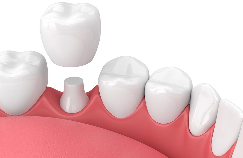Tooth Restoration Ottawa ON