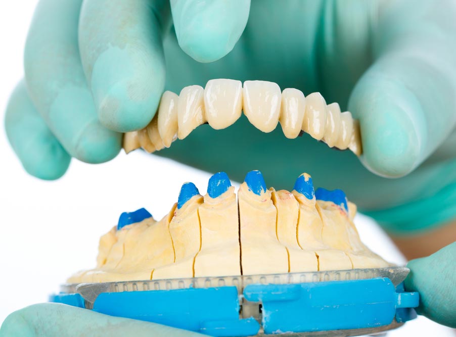 Porcelain teeth – dental bridge