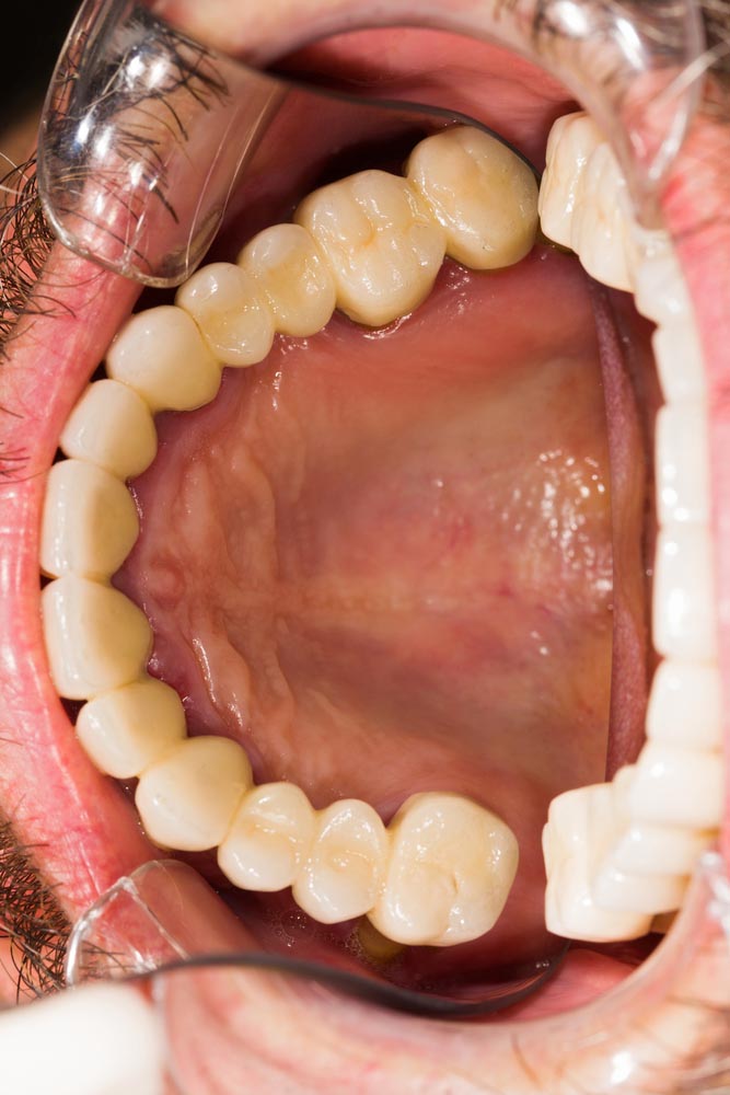 Dental Crowns and Bridges Dental Crowns and Bridges