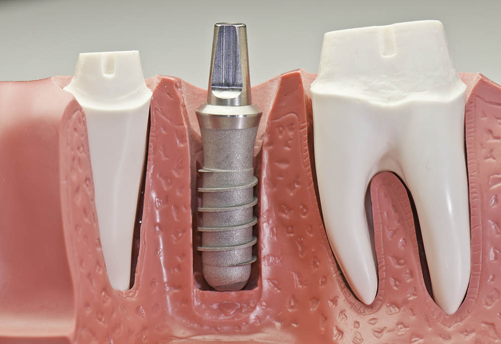 Dental Implant Model Dental Implant Model