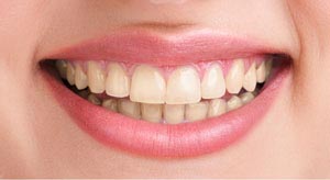 Teeth Whitening Ottawa ON Teeth Whitening Ottawa ON