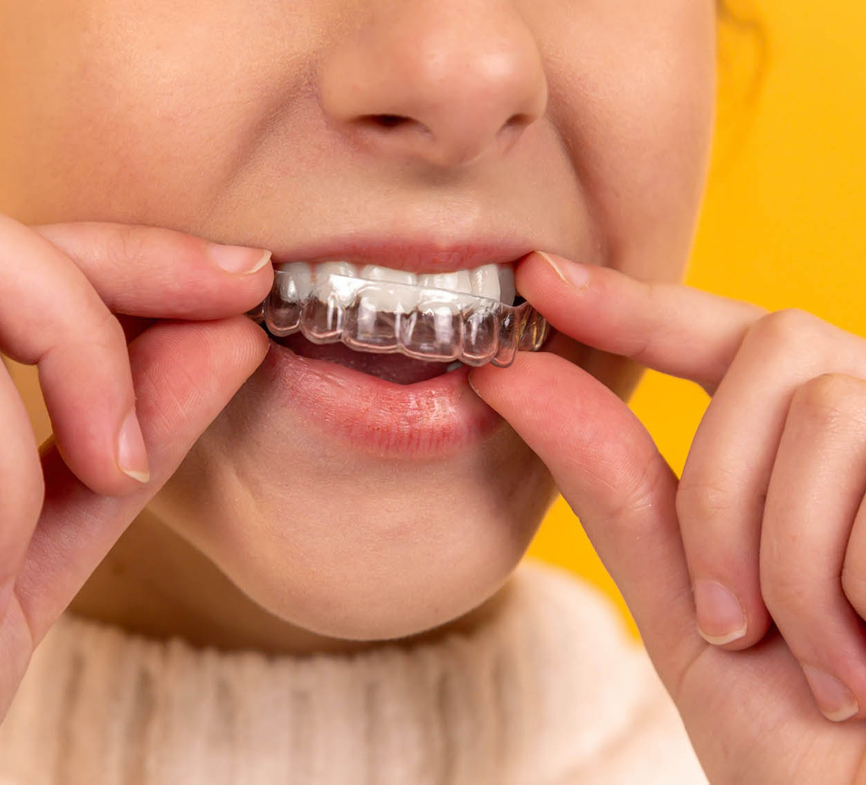 Clear Aligners Ottawa ON Clear Aligners Ottawa ON